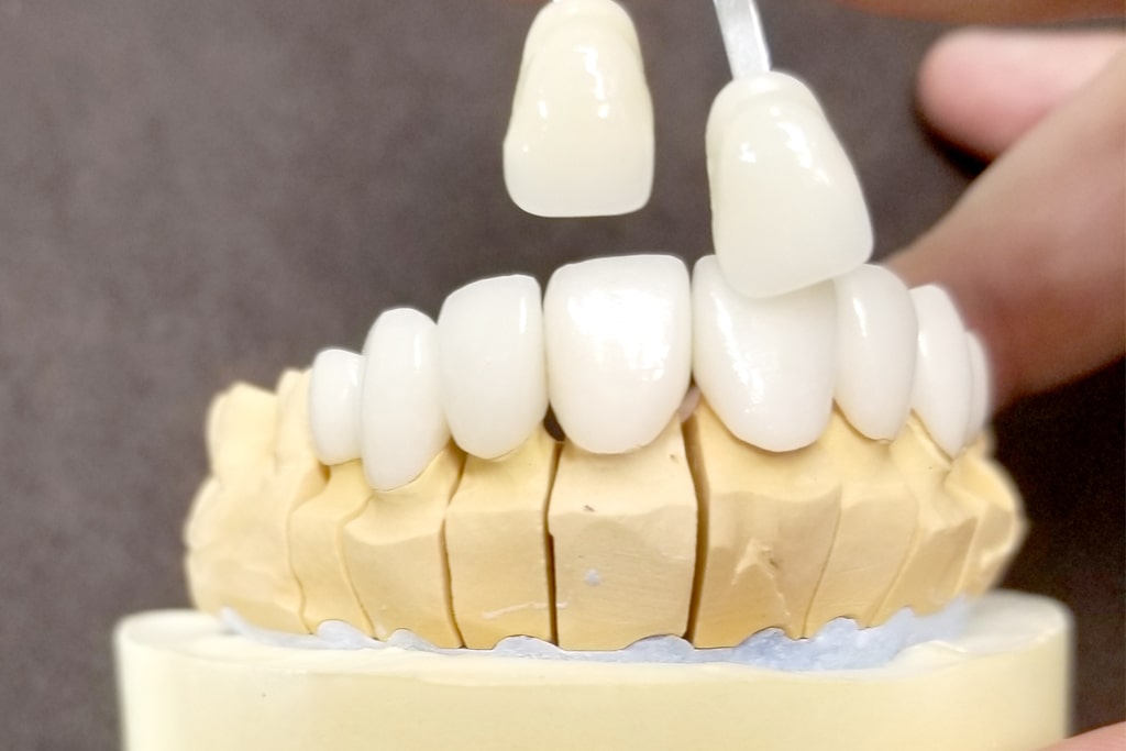精密機器と歯科技師が高水準の修復物を作ります。