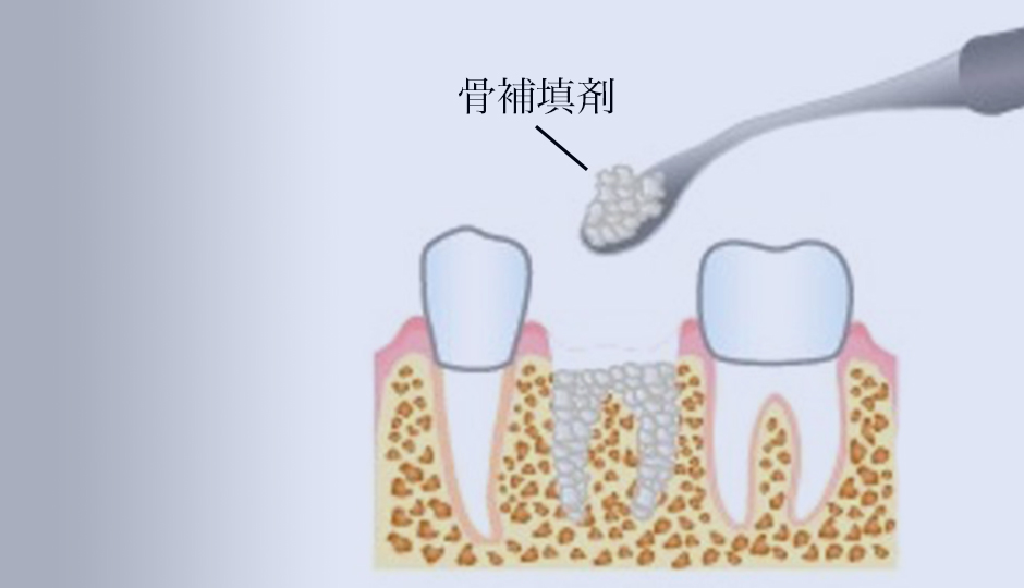 歯を抜く段階からの適切な処置で安定性の高いインプラントを実現